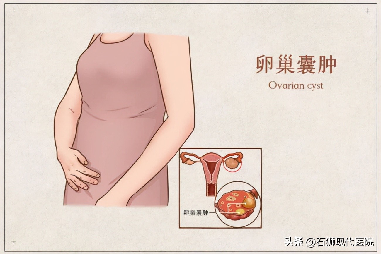 妇科|卵巢囊肿:庄稼还是杂草