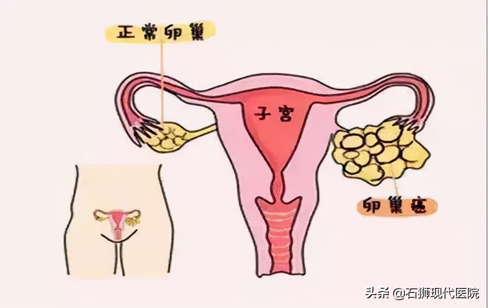 20多岁女孩肚子痛查出卵巢囊肿,没有X生活为啥还会得妇科病?