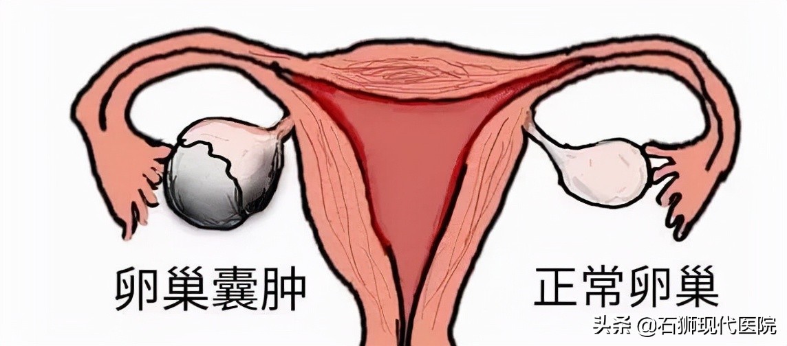 20多岁女孩肚子痛查出卵巢囊肿,没有X生活为啥还会得妇科病?