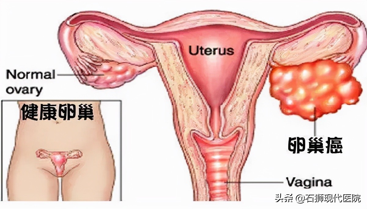 20多岁女孩肚子痛查出卵巢囊肿,没有X生活为啥还会得妇科病?