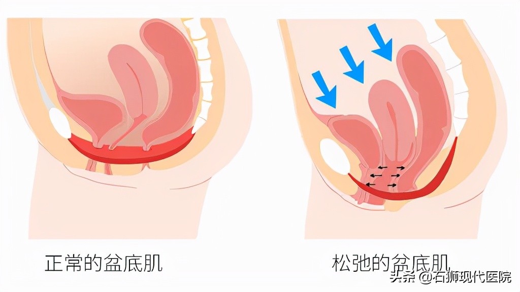 生娃后,阴道松弛、漏尿、妇科病?如何改善,就要做好这件事