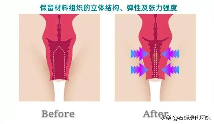 在魅力女性圈火爆多年的生物束带紧缩术,为爱“紧”上添花
