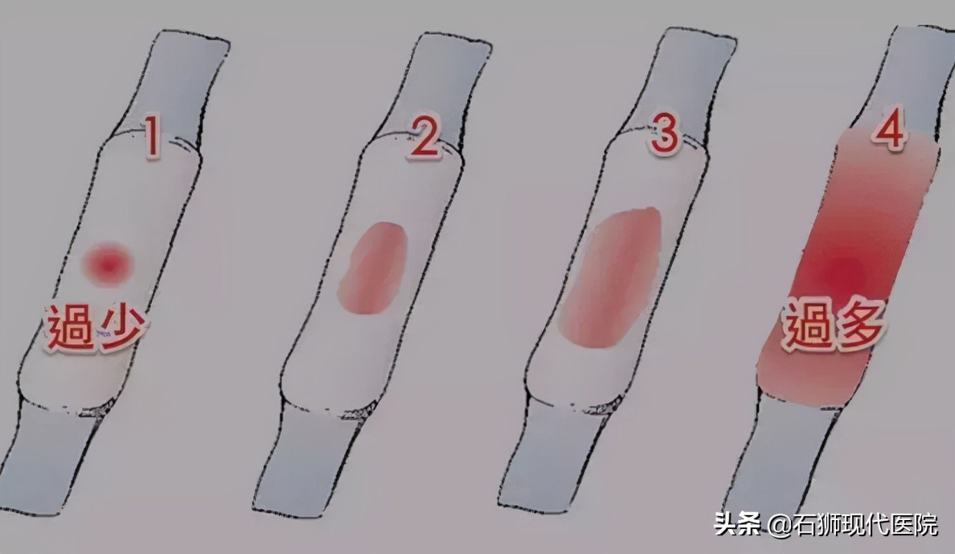 大姨妈情况暗示生育能力?这6种异常情况,赶紧去做检查