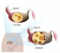 想怀孕！多囊卵巢综合征如何诊断治疗