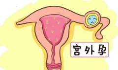 宫外孕不能大意！早孕的姐妹们当心了