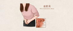 盆腔炎，女性朋友们要小心！