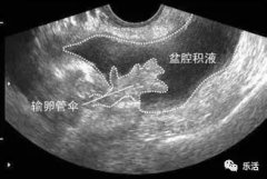 石狮妇科医院 | 小腹坠胀？可能是盆腔