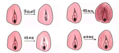 夜夜痒醒难入眠？当心‘外阴白斑’缠