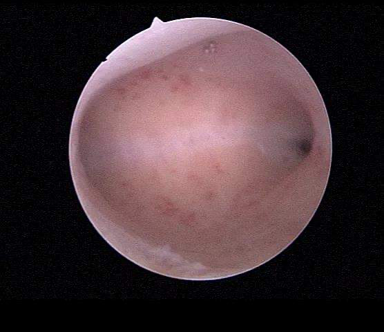 正常的宫腔形态是这样的.png 图片