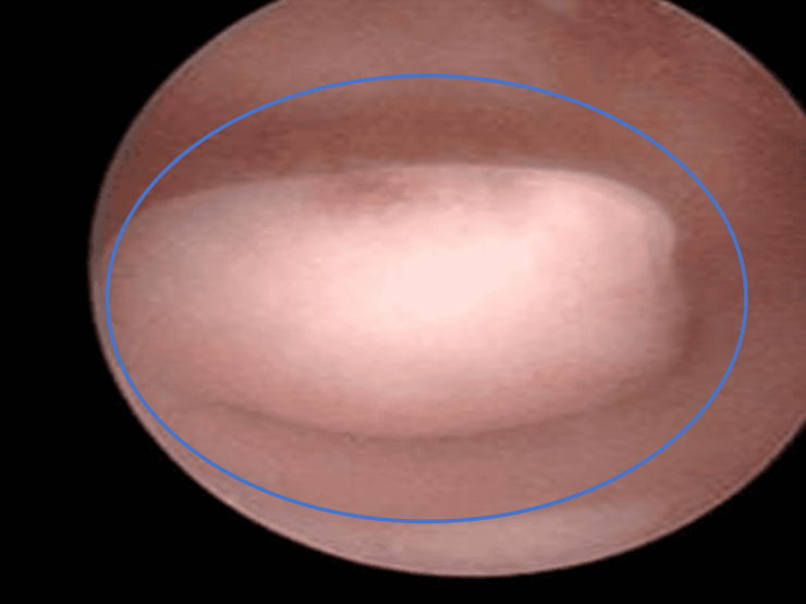 篮圈里的就是内膜息肉.png 图片