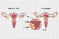 科普 | 子宫内膜癌如何快速识别？妇科